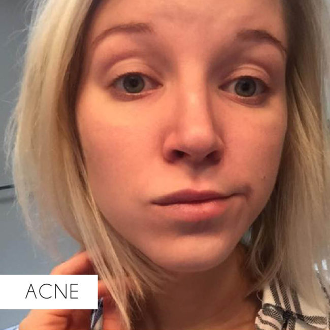 acne